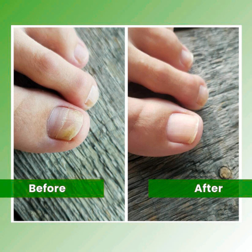 Emberlei™ - Nail Fungus Laser