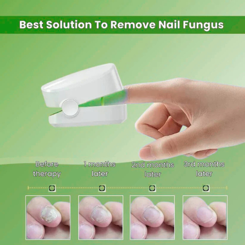 Emberlei™ - Nail Fungus Laser
